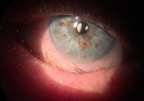 Entropion of the lower eyelid